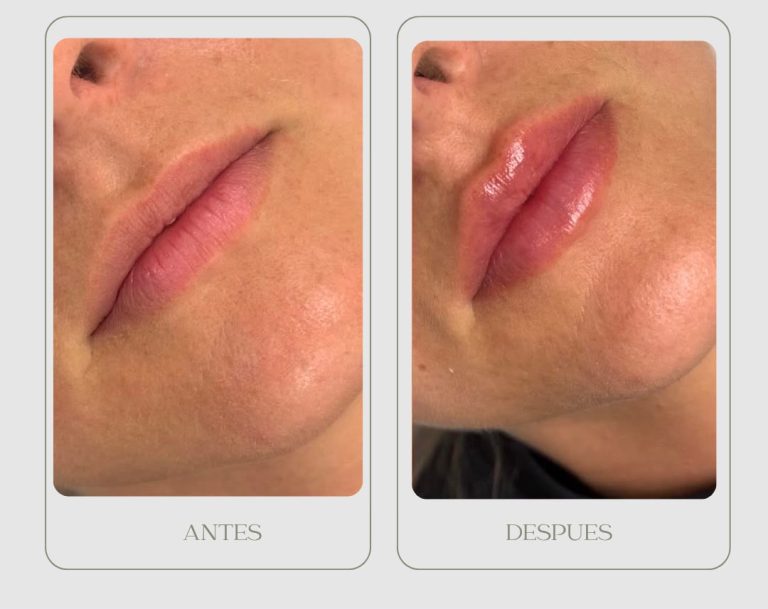 PHOTO-2026-08-11-12-10-09 2Aumento labios