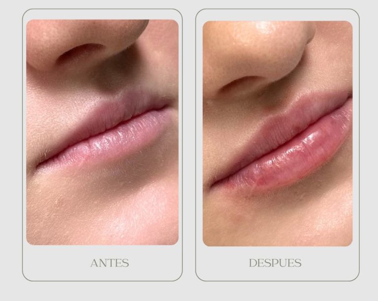 PHOTO-2026-08-11-12-10-09 3Aumento labios