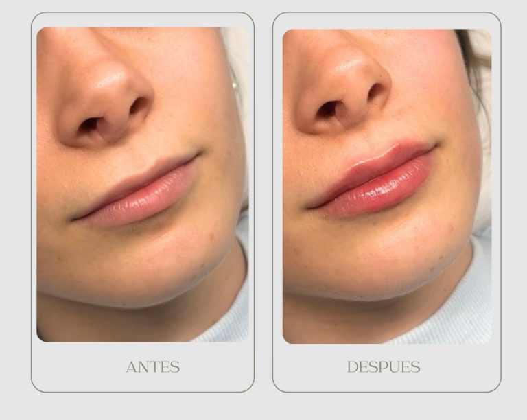 PHOTO-2026-08-11-12-10-09 4Aumento labios