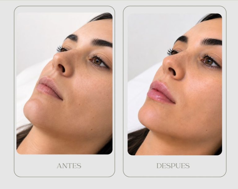 PHOTO-2026-08-11-12-10-09Aumento labios