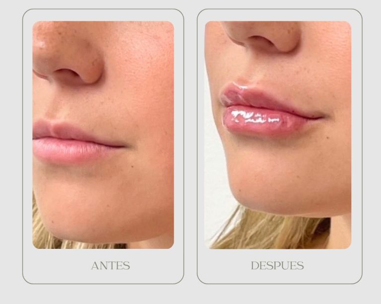 PHOTO-2026-08-11-12-10-10Aumento labios